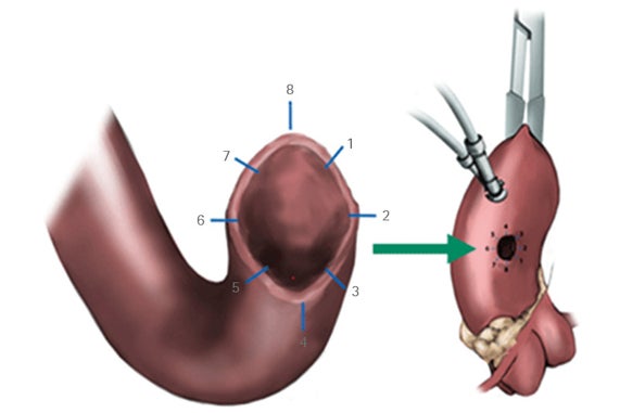 CABG Proximal anastomosis technique